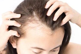Hair Thinning