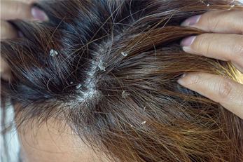 Dandruff & scalp infections
