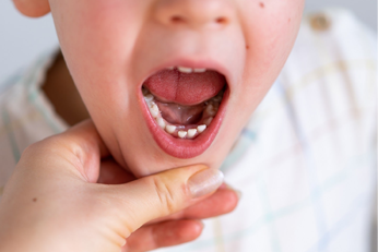 Treat oral infection and ulcer