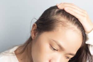 Alopecia